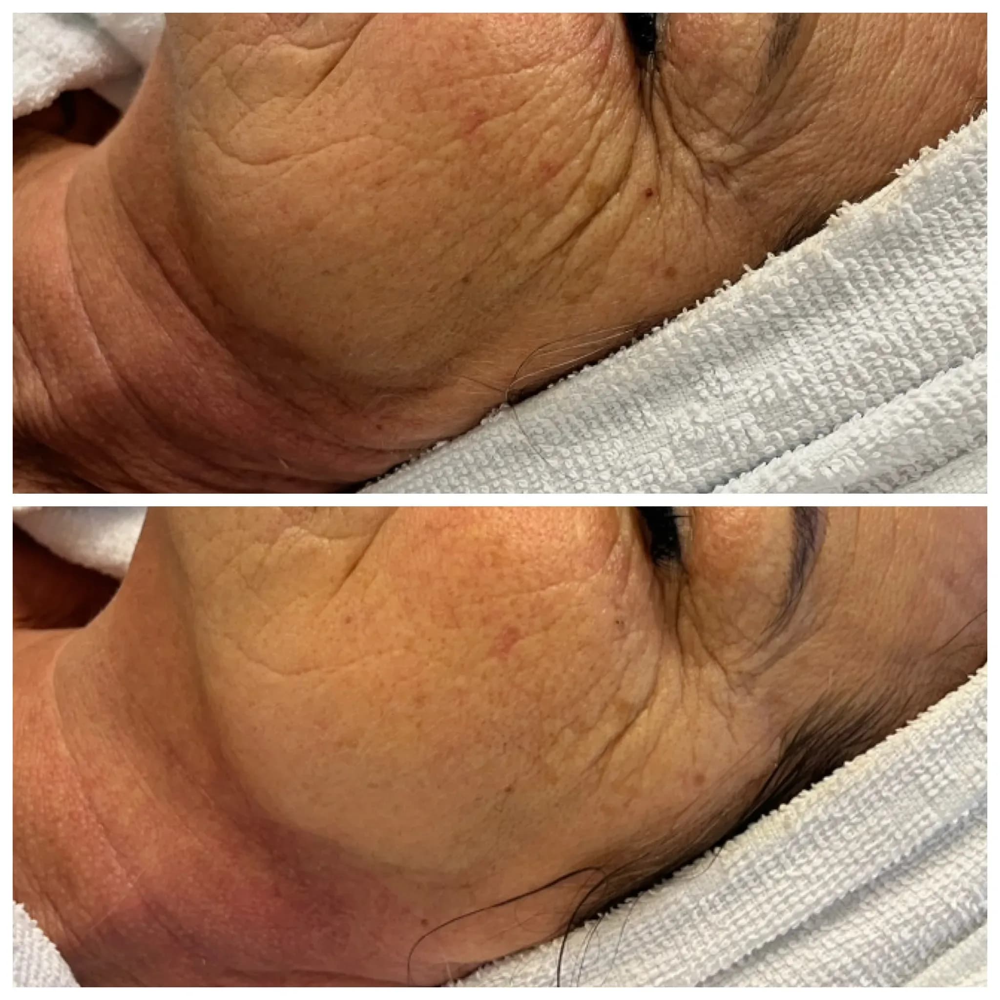 Professionelle Anti Aging Gesichtsbehandlung