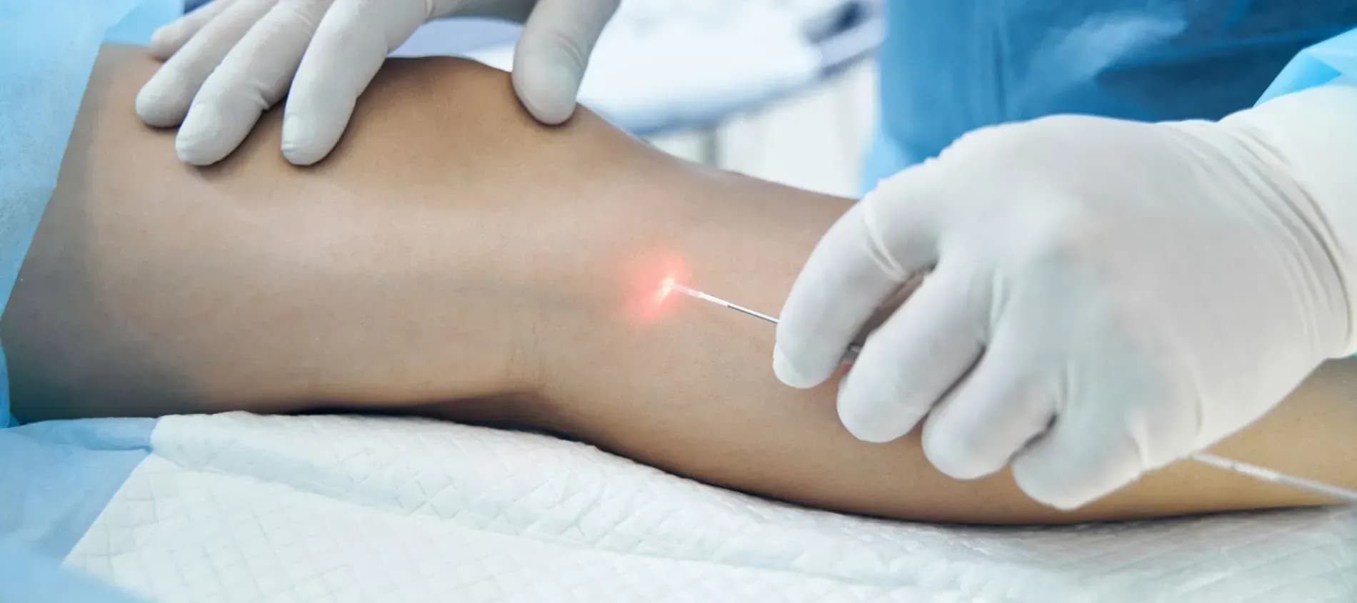 Krampfadern schonend entfernen in Salzburg – Laserbehandlung beim Spezialisten