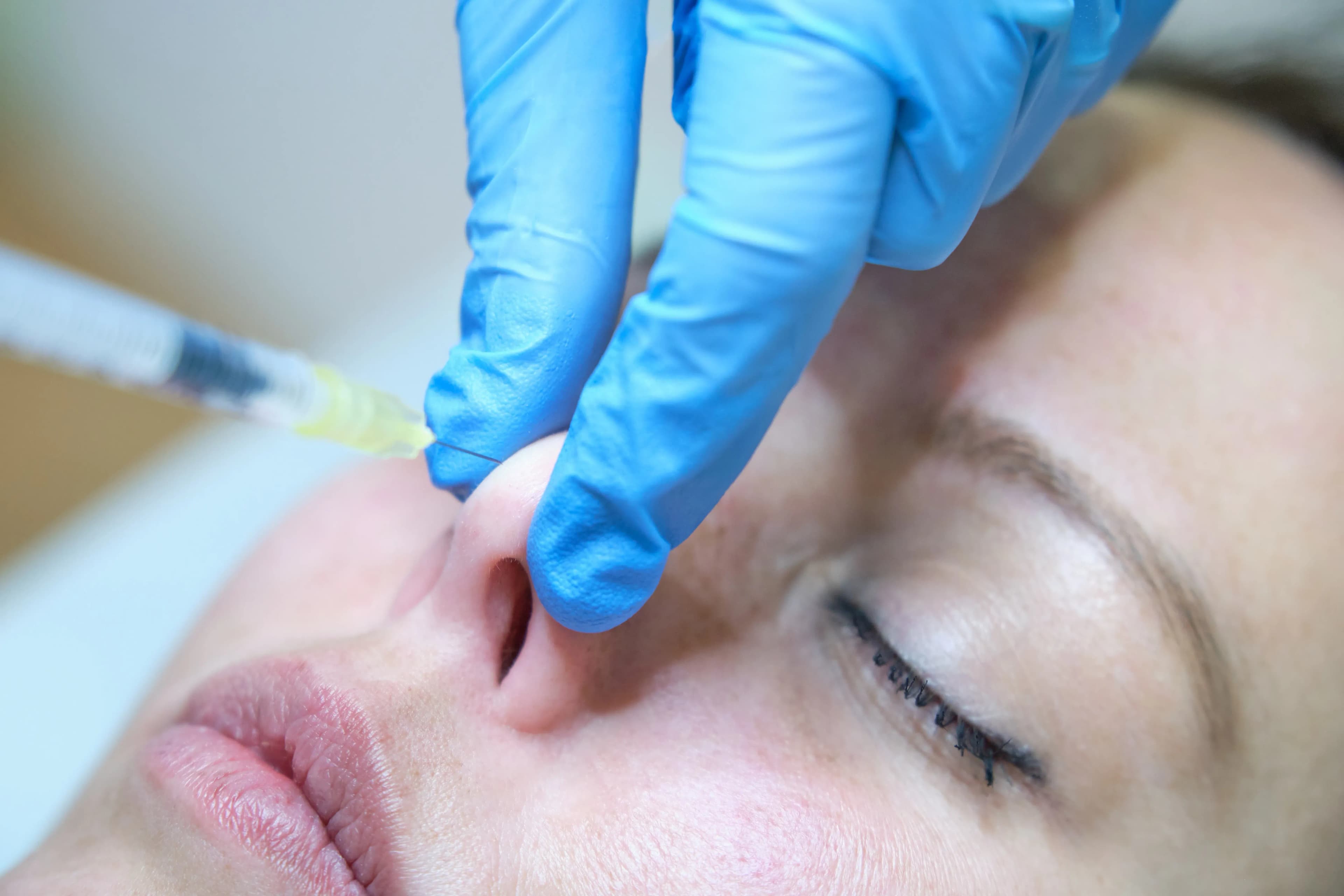 Nasenspitze korrigieren lassen in Köln - Präzise & minimalinvasive Techniken