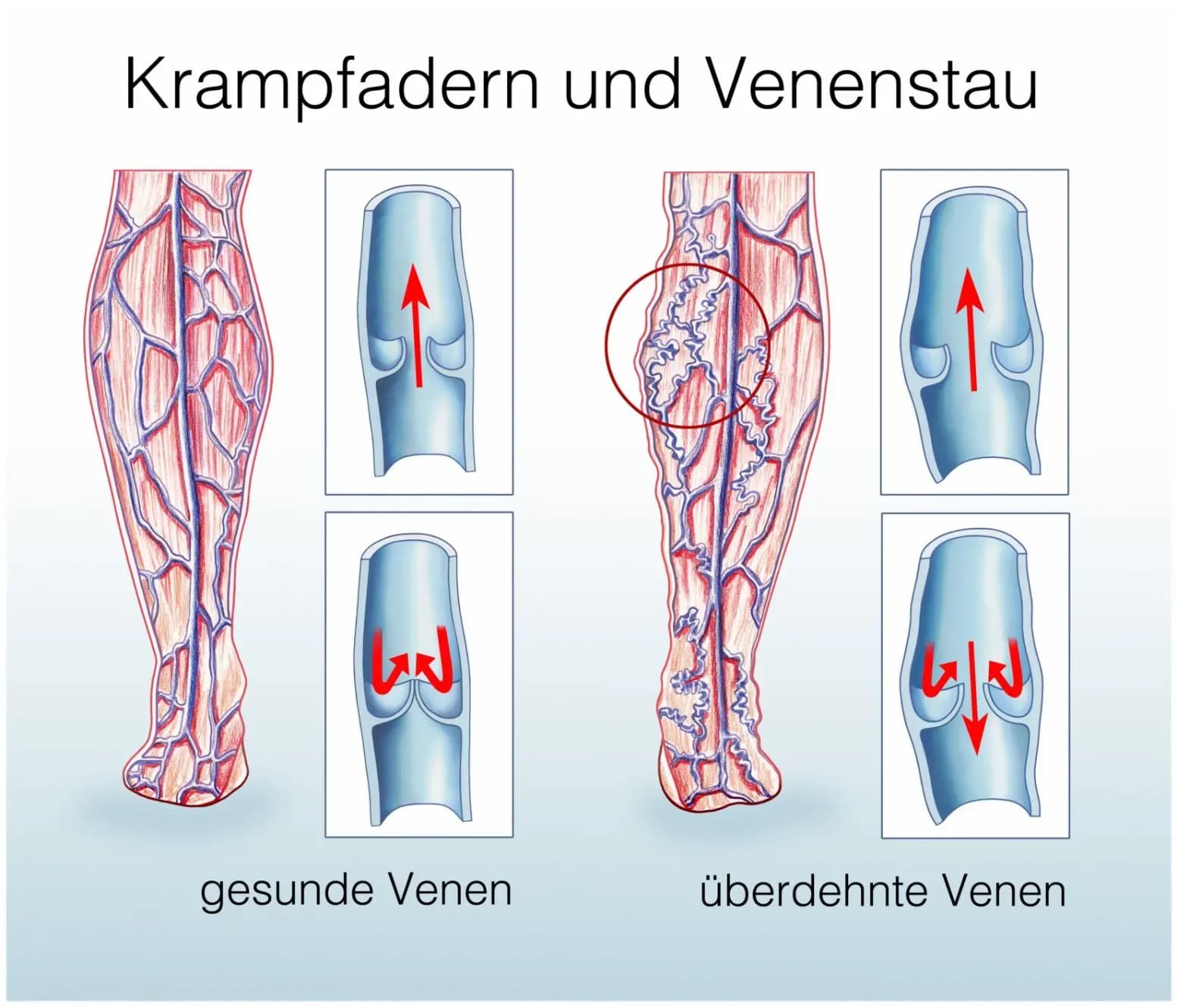 Welche Beschwerden verursachen Krampfadern?