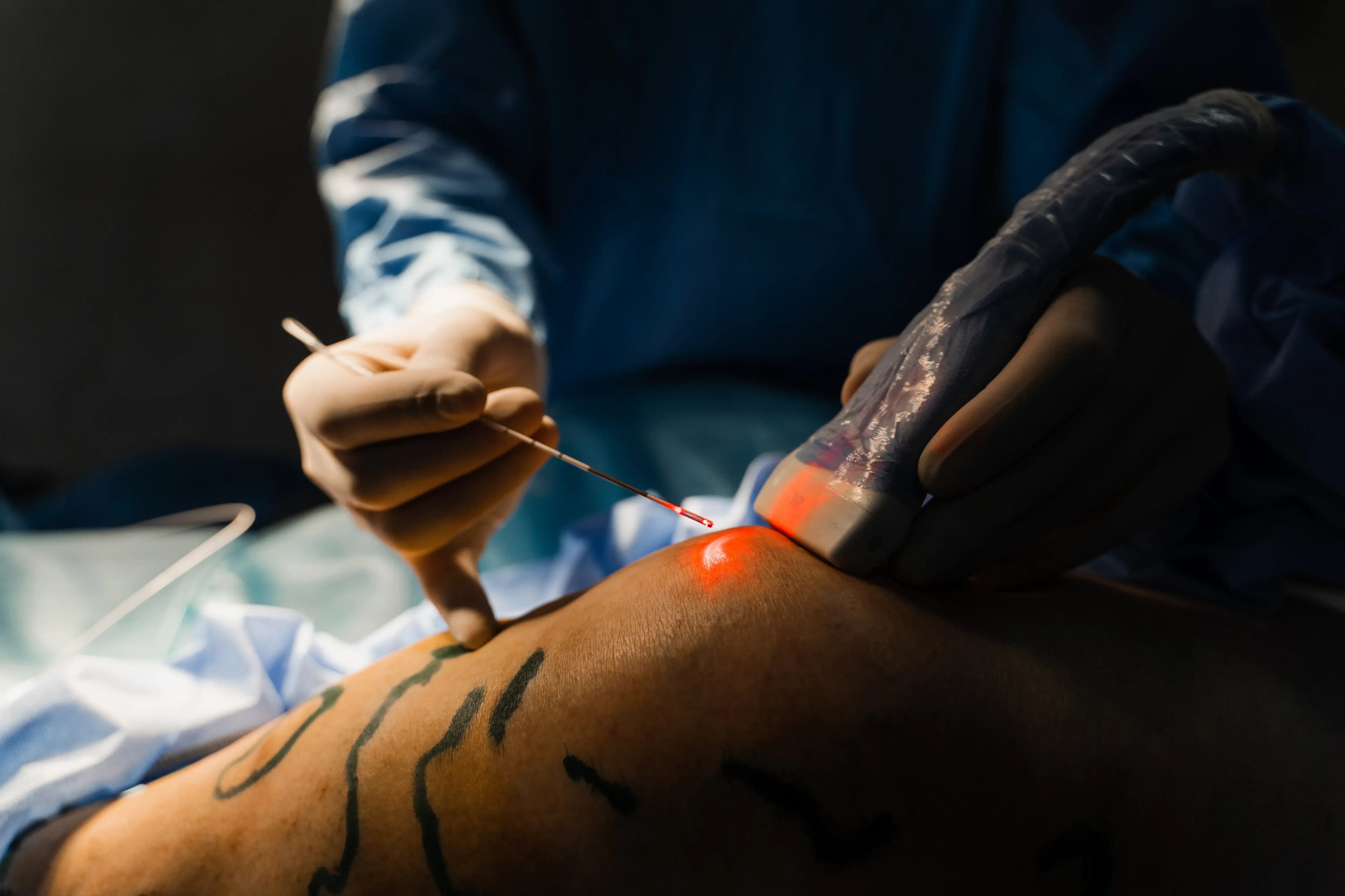 Krampfadern entfernen mit Laser – Wie funktioniert die Behandlung?